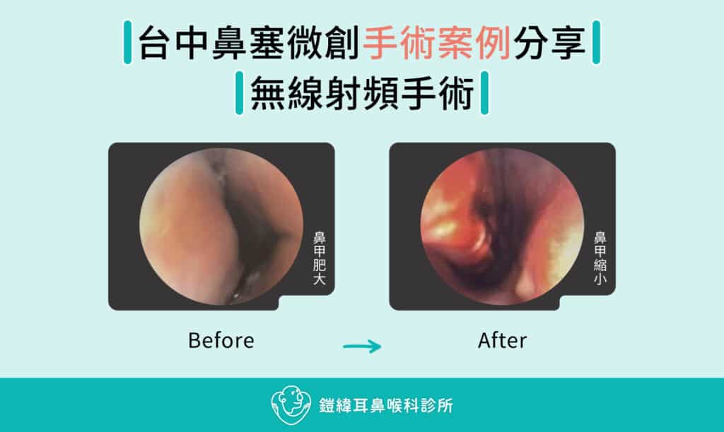 台中鼻塞微創手術案例分享、無限射頻手術前後對比、從鼻甲肥大到術後鼻甲縮小