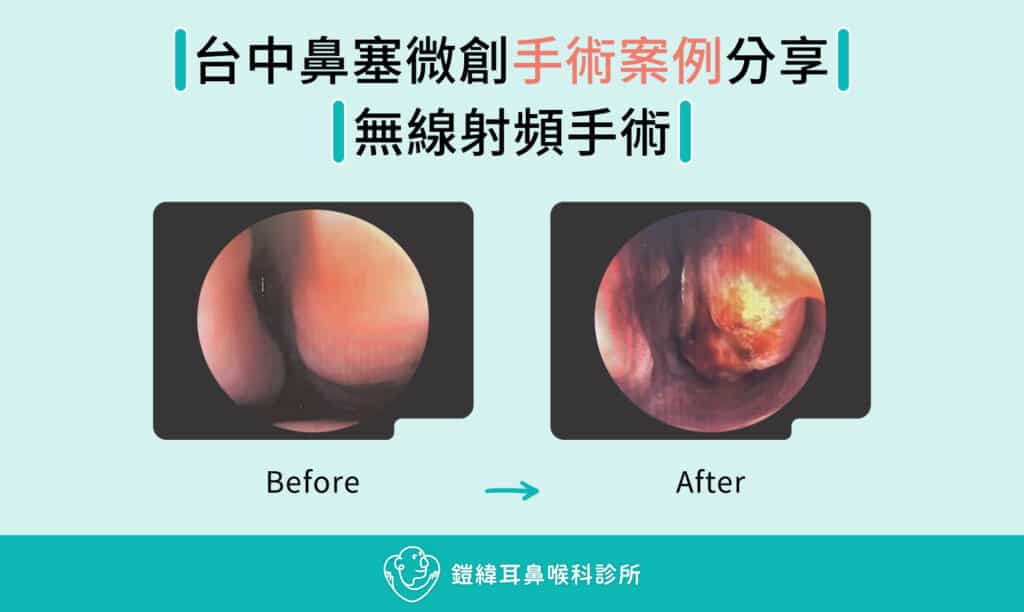 無線射頻鼻塞手術案例分享:內視鏡影像展示微創手術改善下鼻甲腫脹之效果,有效解決長期鼻塞問題